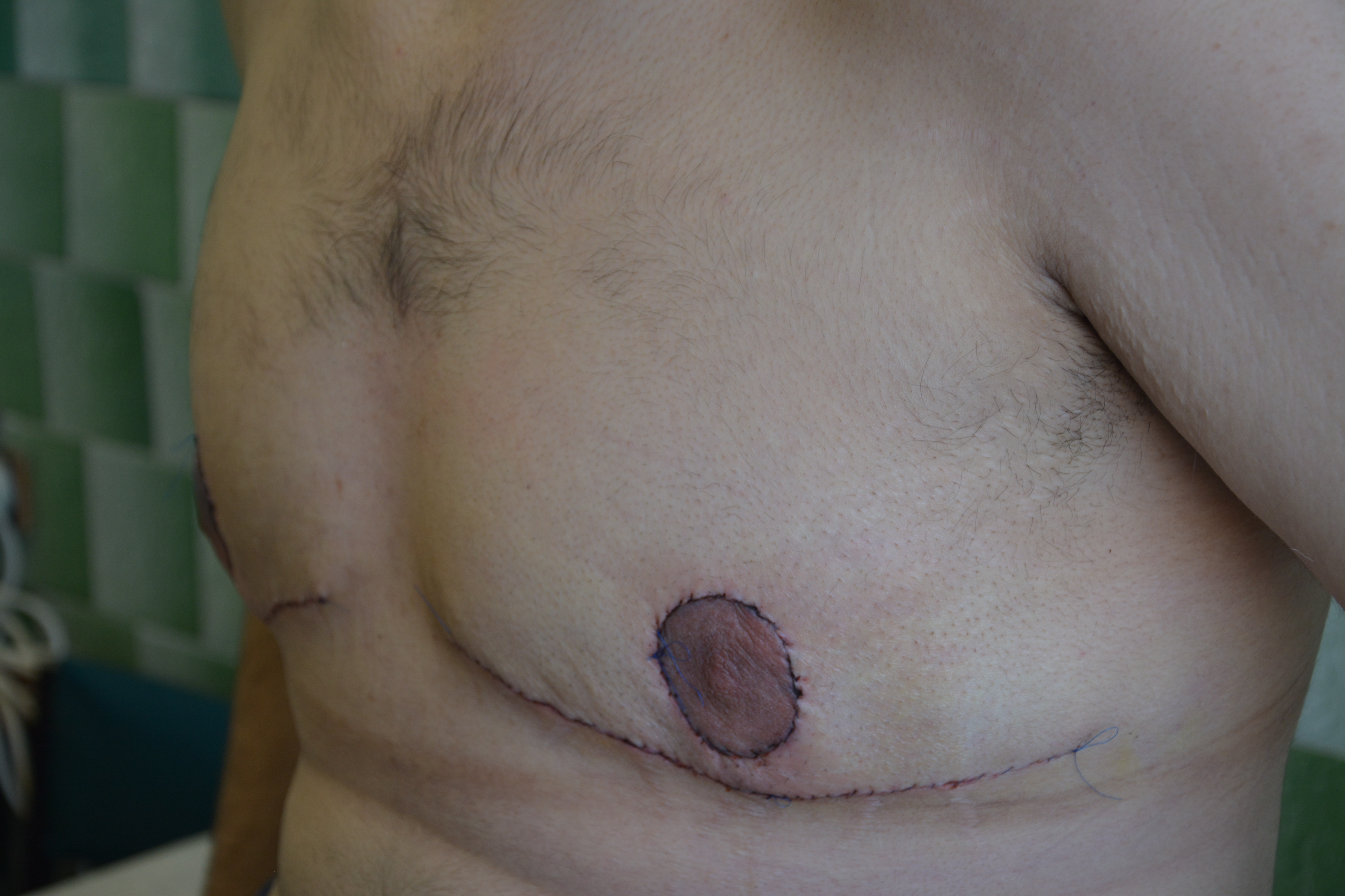 варикоз на груди у мужчин фото 52