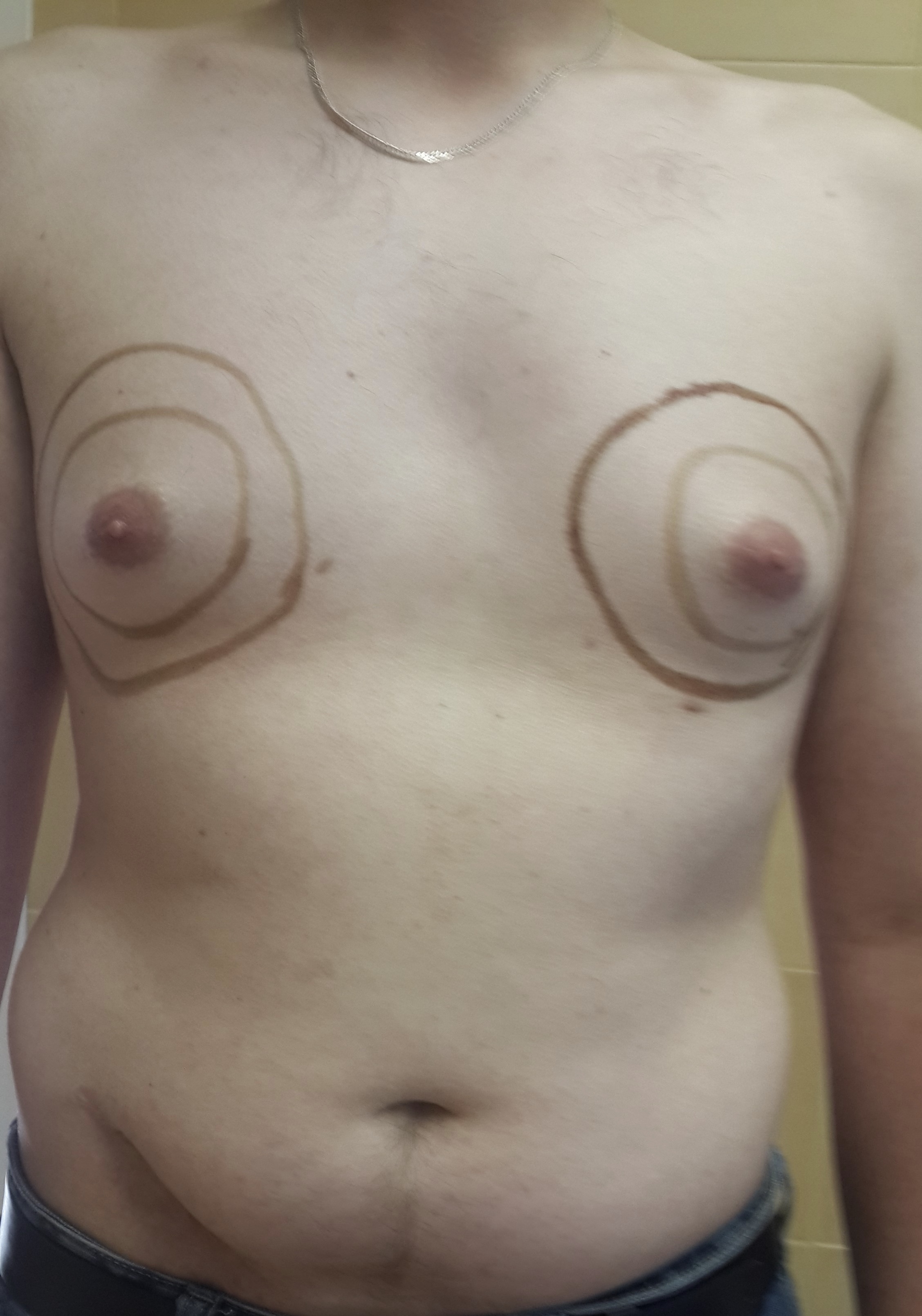 опухоль на левой груди у мужчин фото 108