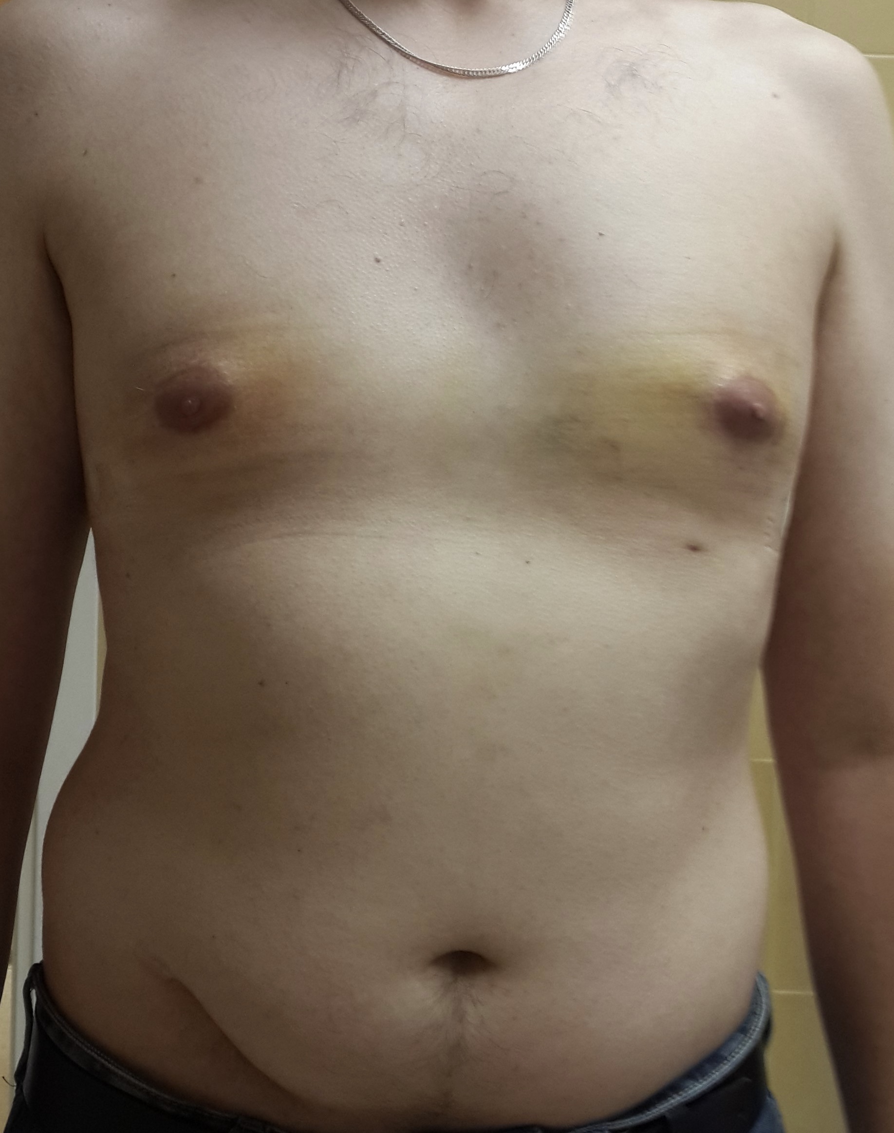 асимметрия груди у мужчин фото 35