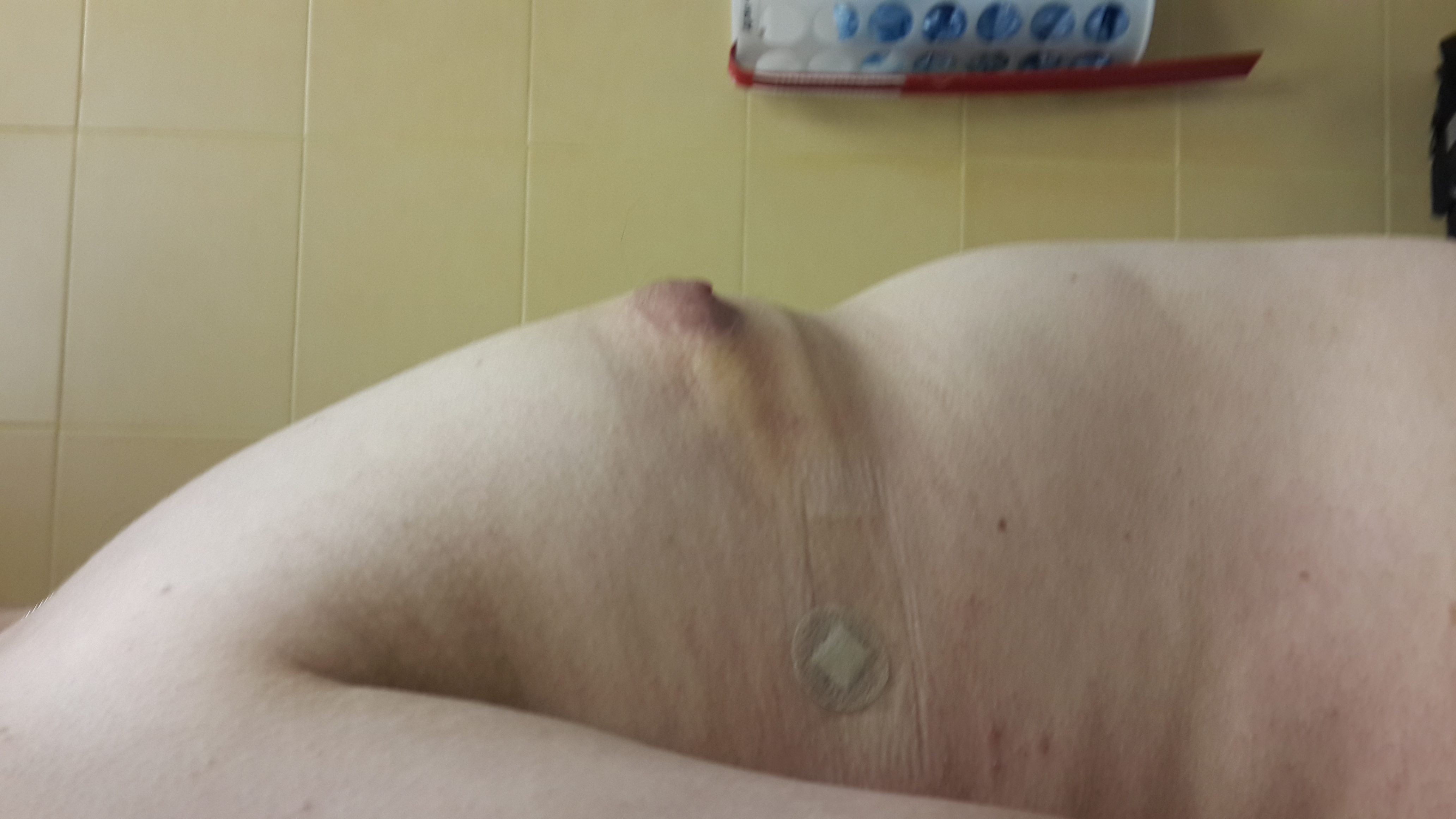 удаления жира из груди у мужчин фото 12
